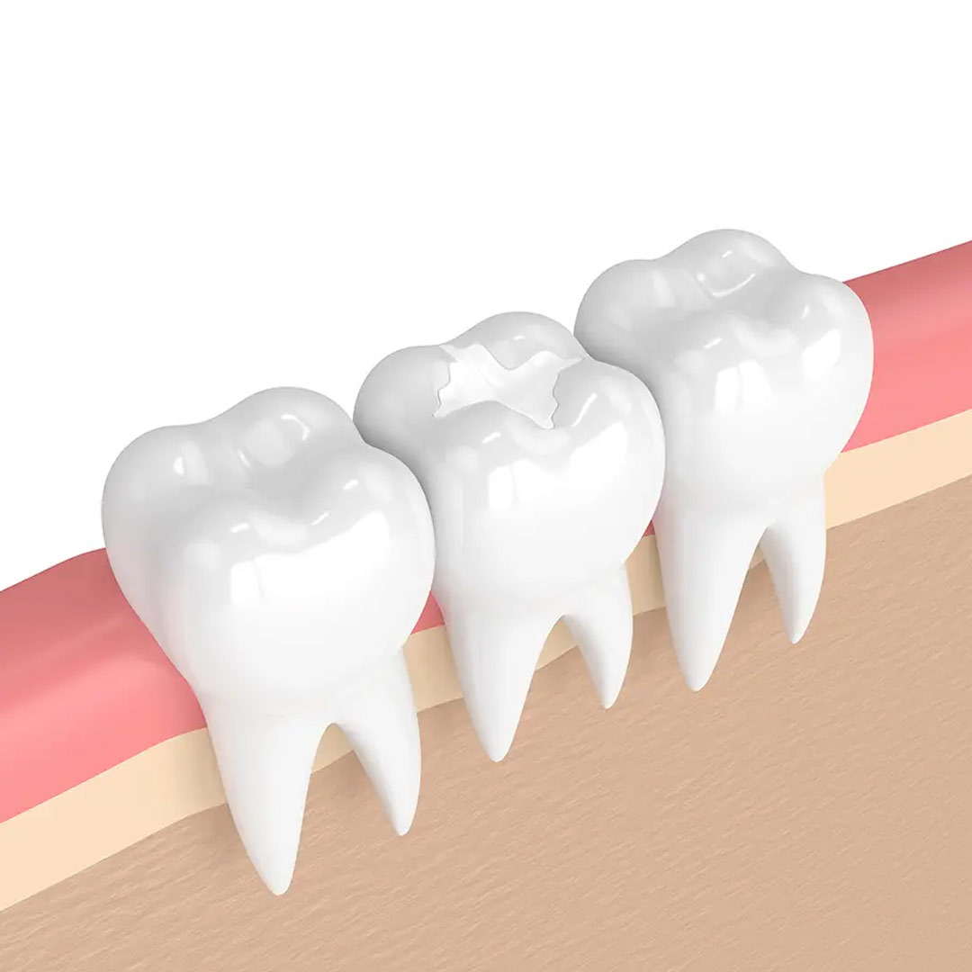 Dental Restorations available in online  pharmacy qatar, doha 